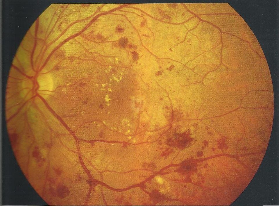 Retinopatia