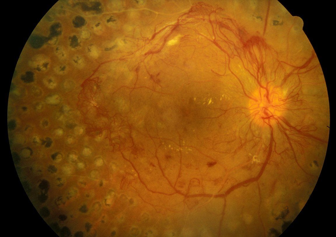 Retinopatia diabetica