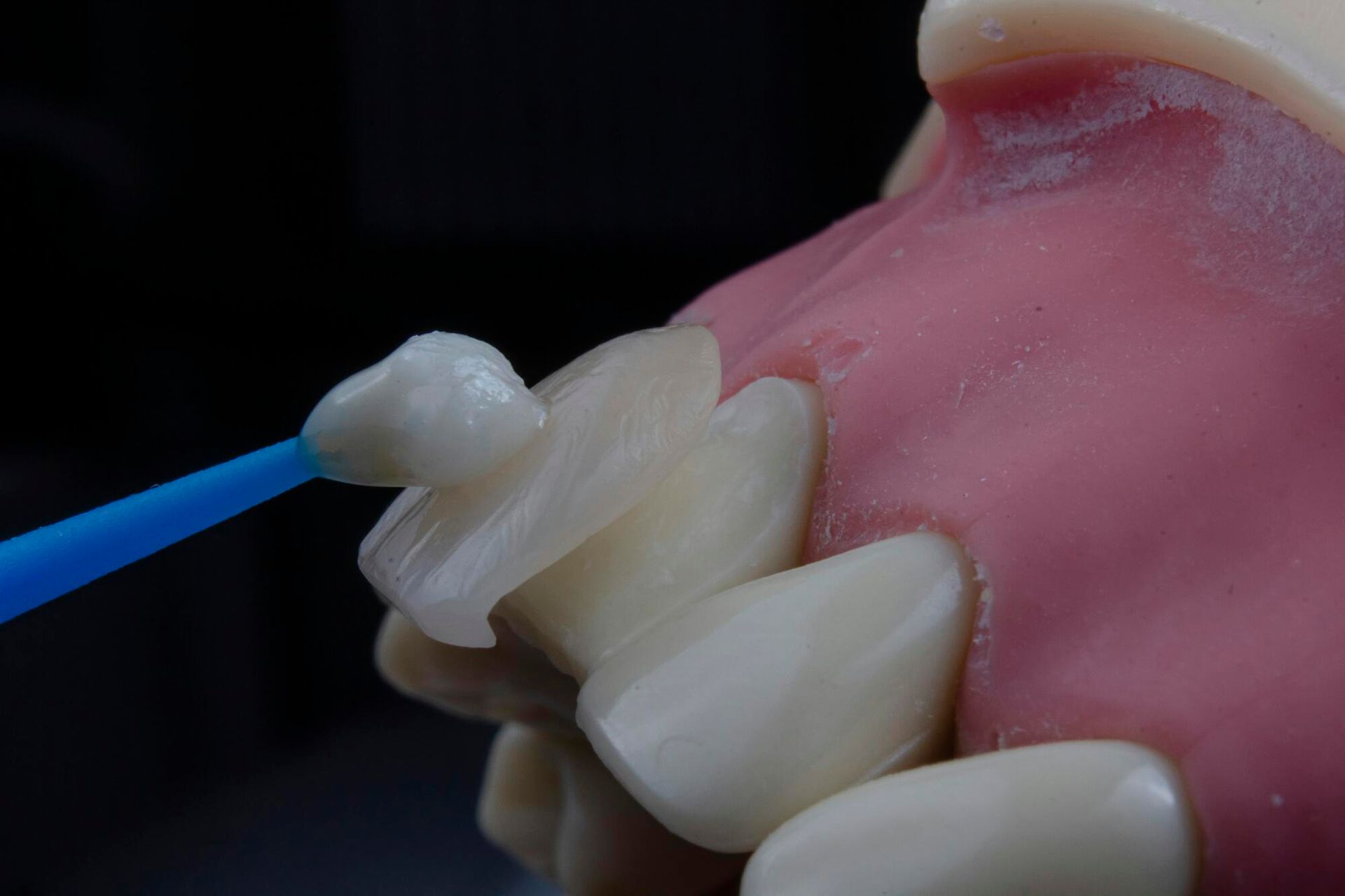 A dentist applying a bonding agent to a porcelain veneer on a model of teeth.