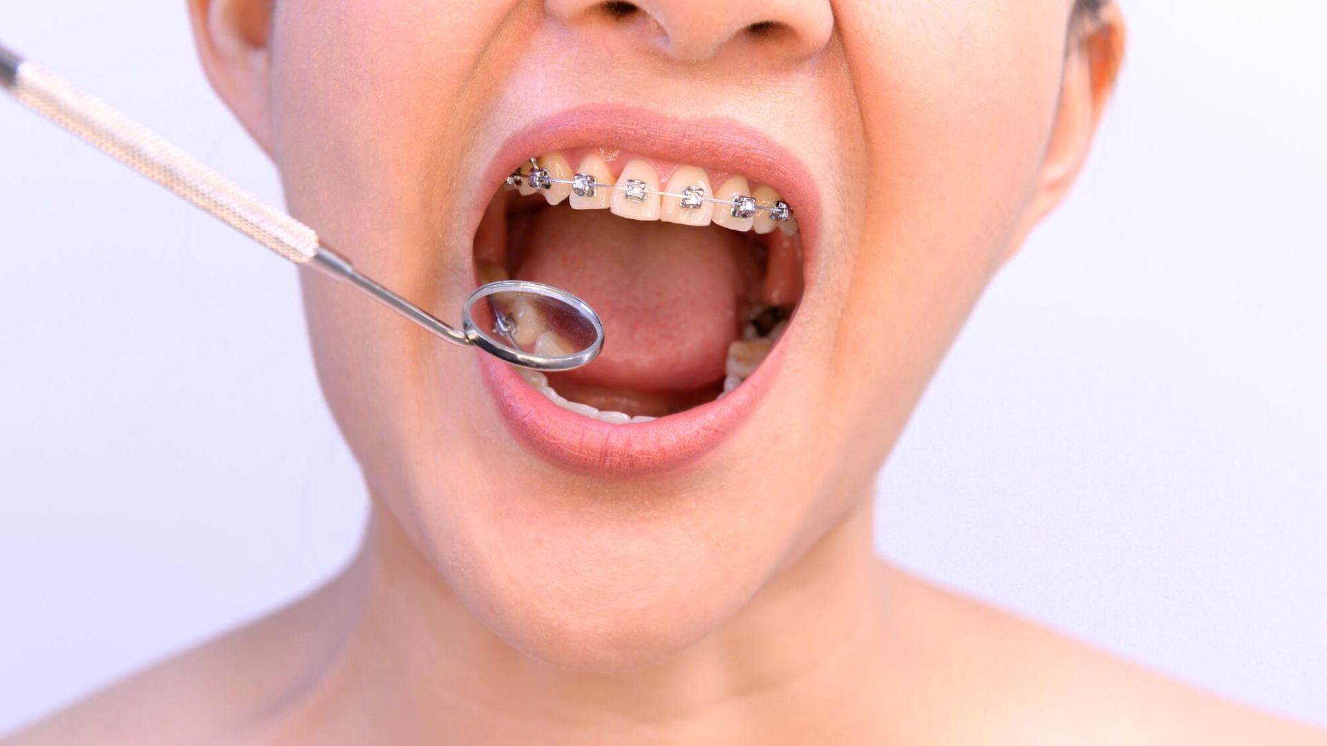 A woman with braces is getting her teeth examined by a dentist.