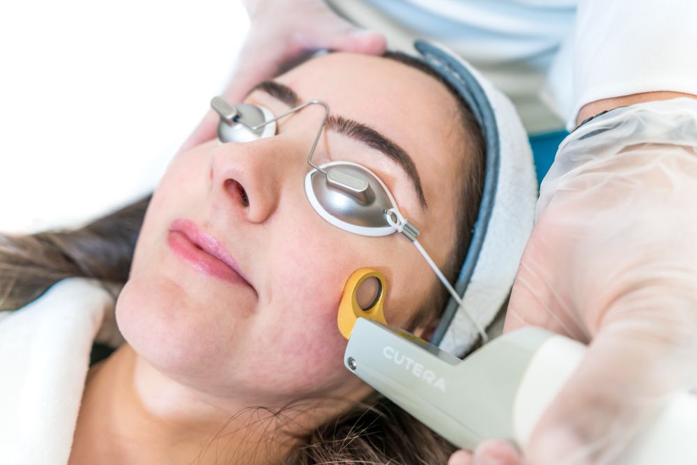 Woman receiving laser skin treatment on her cheek; wearing eye protection.