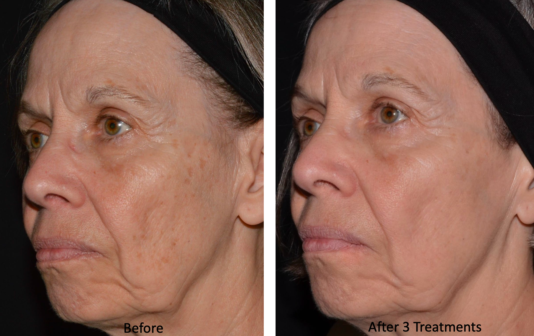 A before and after photo of a woman 's face.