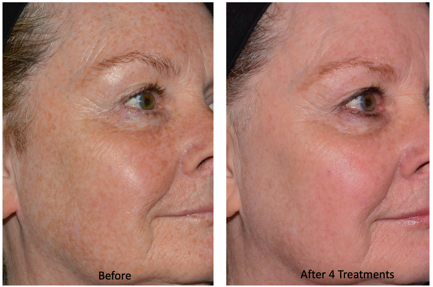 A before and after photo of a woman 's face.