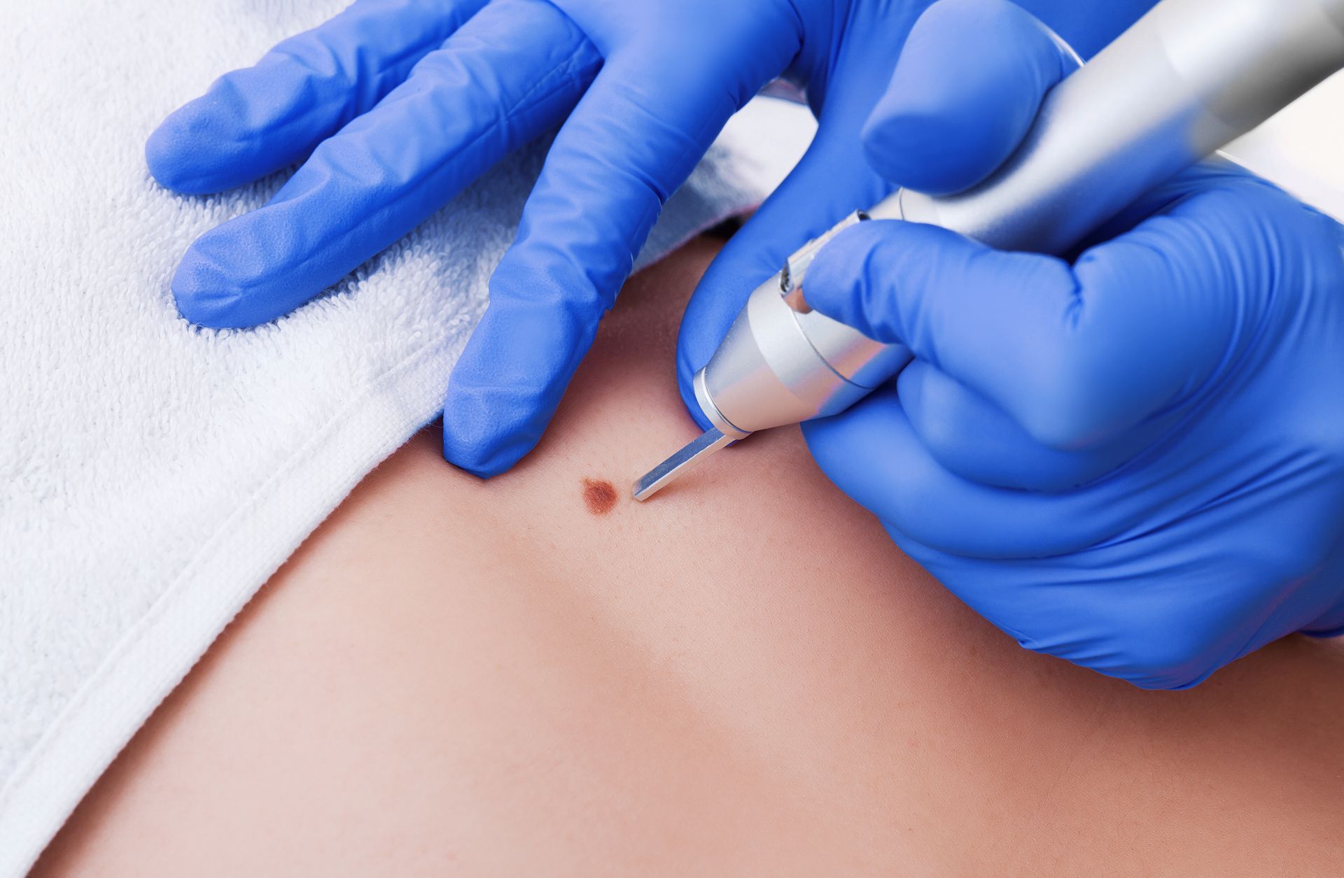 A person is using a machine to remove a mole from a person 's skin.