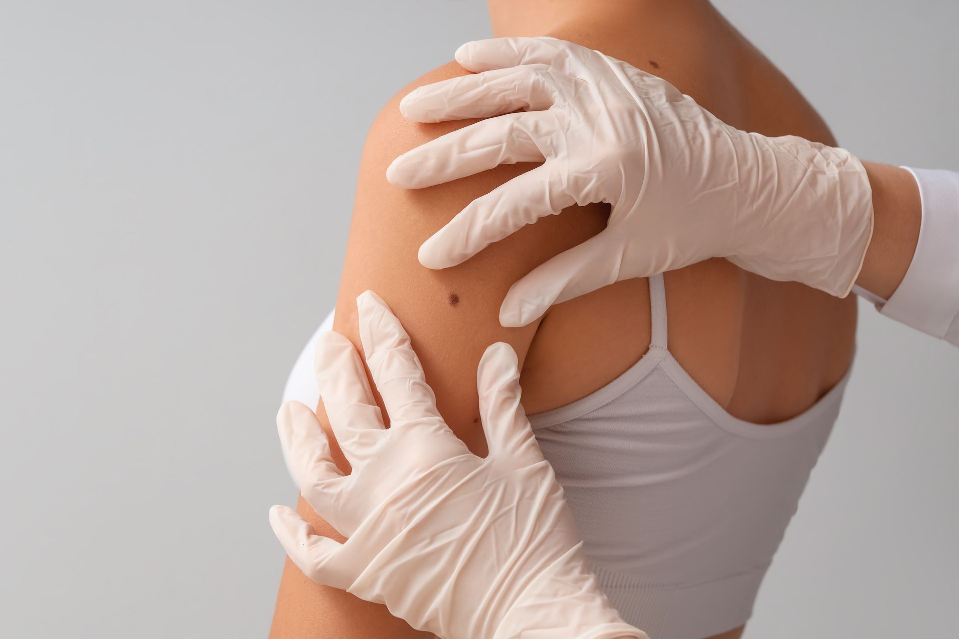 A medical professional in white gloves examines a small mole on a person's upper arm against a plain gray background.