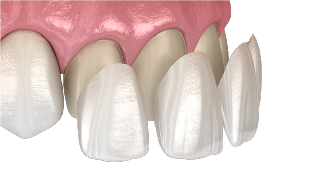 Veneers und Zirkonkeramik