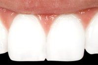 Cosmetic Bonding - After