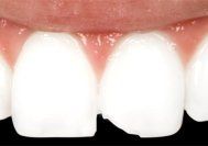 Cosmetic Bonding - Before