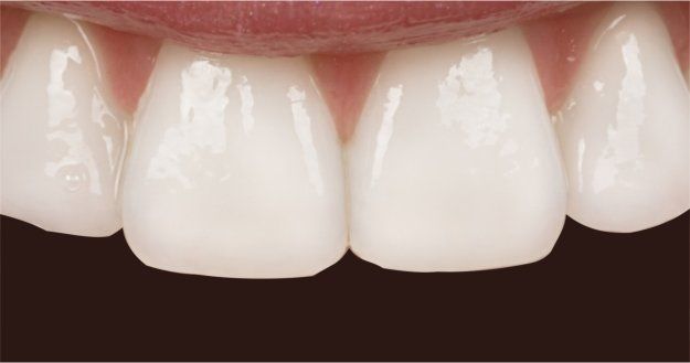 Porcelain Veneers - After