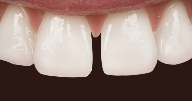 Porcelain Veneers -Before