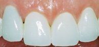 Porcelain Veneers -After