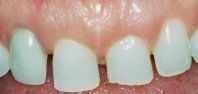 Porcelain Veneers -Before