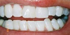 Teeth Whitening - After