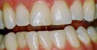 Teeth Whitening - Before