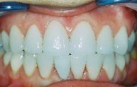 Porcelain Veneers -After