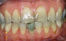 Porcelain Veneers -Before