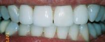 Porcelain Crowns - After