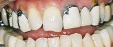 Porcelain Crowns - Before