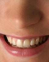 Teeth Whitening - Before