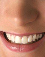 Teeth Whitening - After