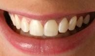 Teeth Whitening - Before