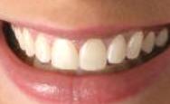 Teeth Whitening - After