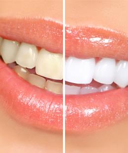 Before and After Dental - Andy Tran, DDS & Associates -After