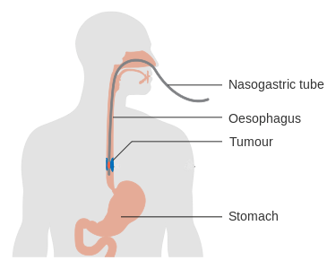 Kidney stone, urinary stone, ureteric stone, renal calculi, renal colic, nephrolithiasis