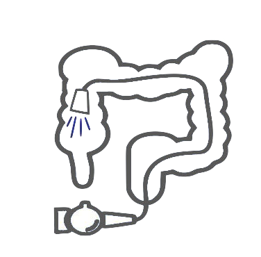 Kidney stone, urinary stone, ureteric stone, renal calculi, renal colic, nephrolithiasis