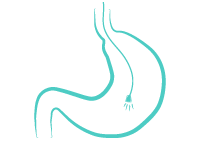 Kidney stone, urinary stone, ureteric stone, renal calculi, renal colic, nephrolithiasis