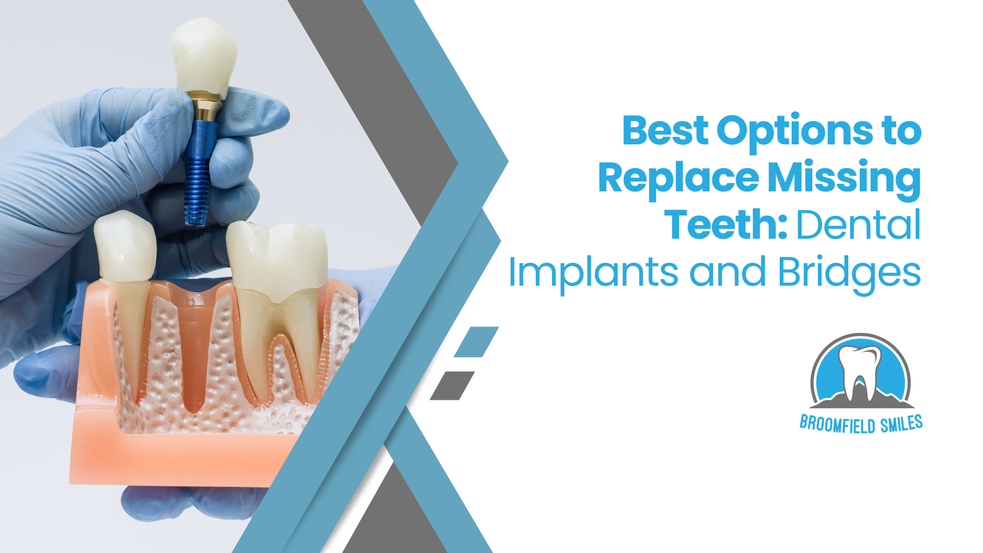 A gloved hand holds a dental model demonstrating a tooth implant procedure, with text about replacing missing teeth.