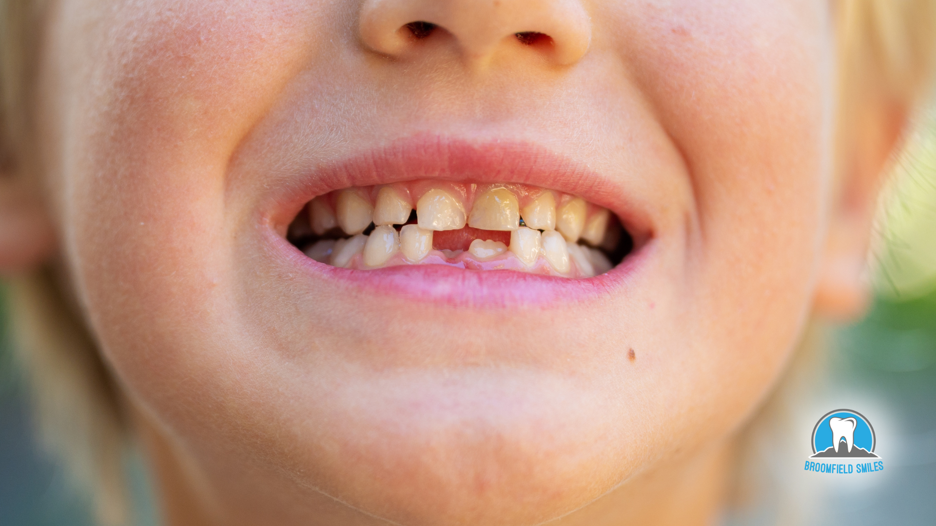 A close up of a child 's mouth with missing teeth.