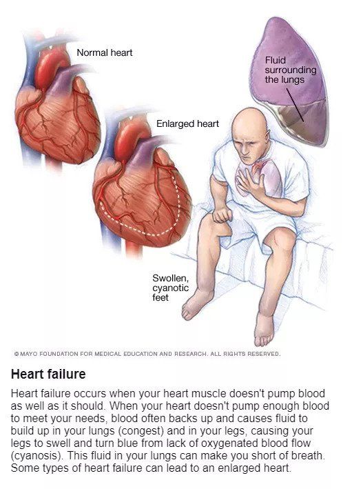 heart failure symptoms