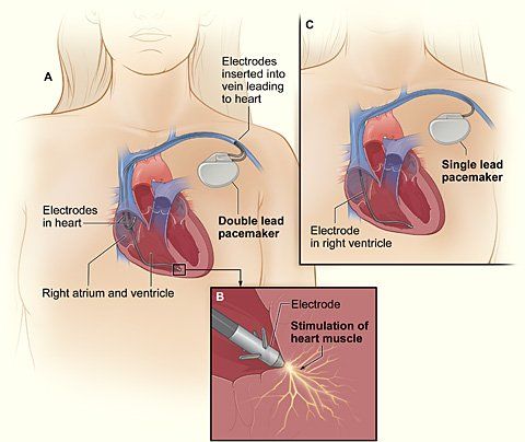 pacemaker implant