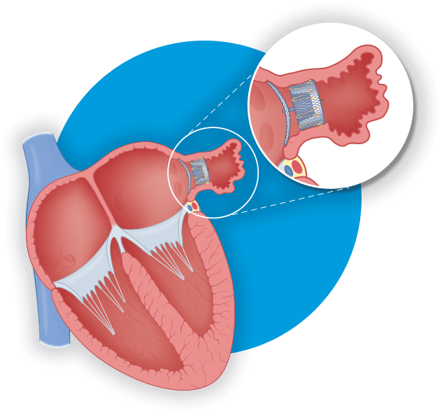 left atrial appendage closure