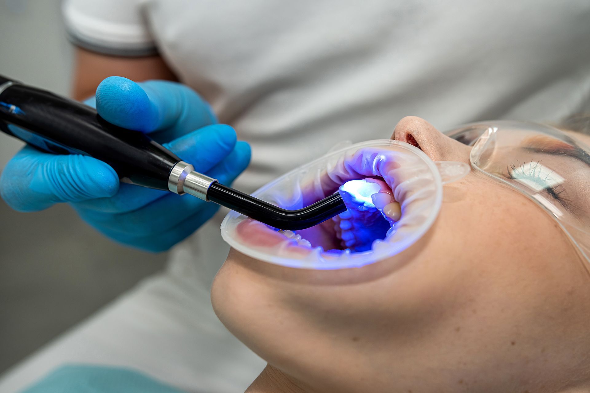 Dentist using a blue light curing device on a patient's teeth during a dental procedure.