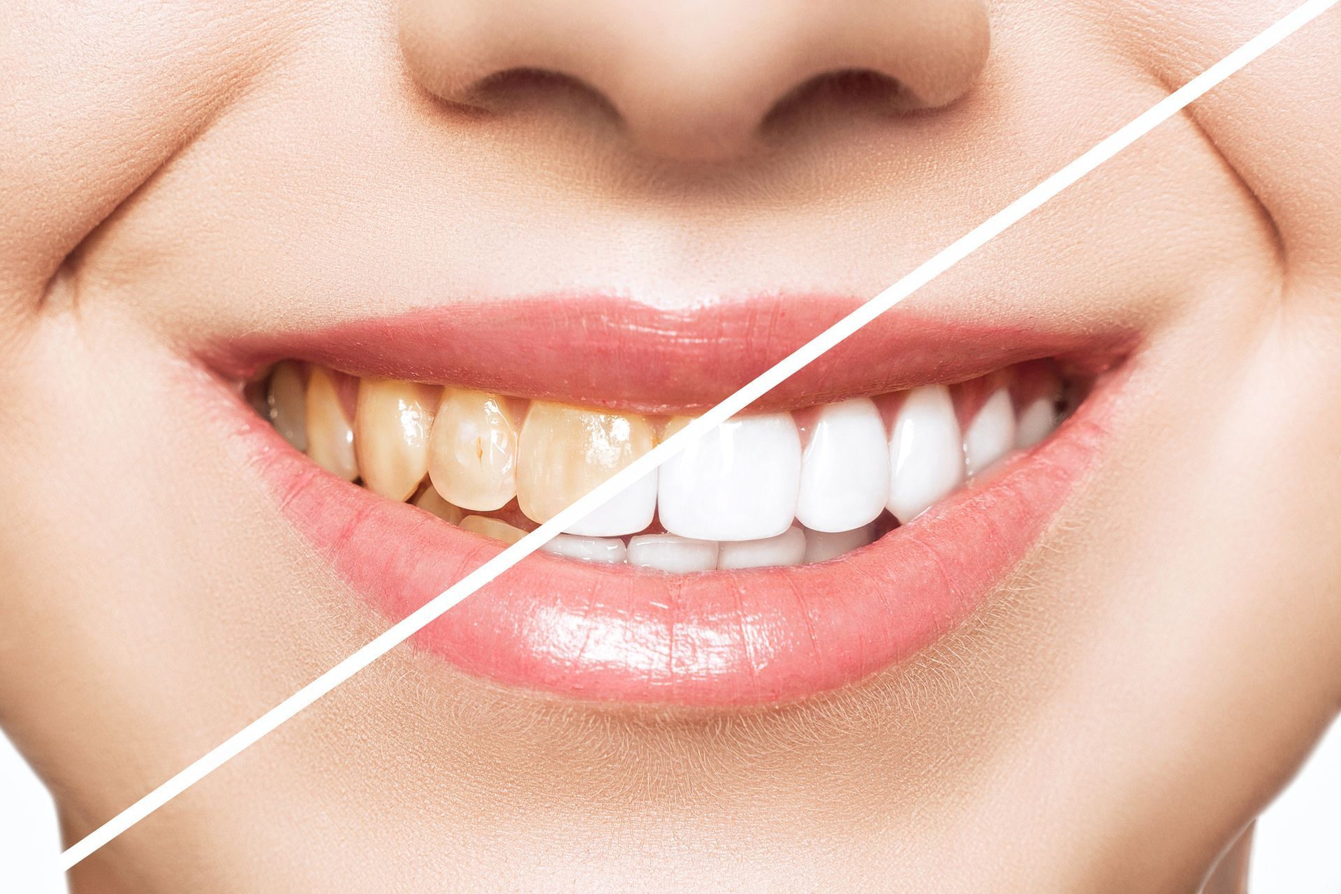 Close up of woman’s teeth showcasing dental whitening before and after treatment results.