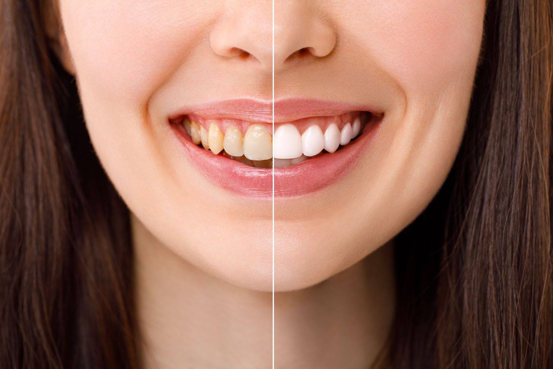 Close-up of a smiling woman showing before and after the dental whitening procedure.