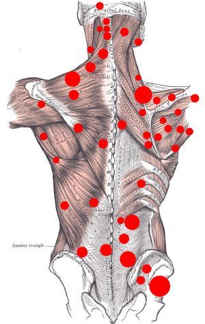 mappa dei trigger point