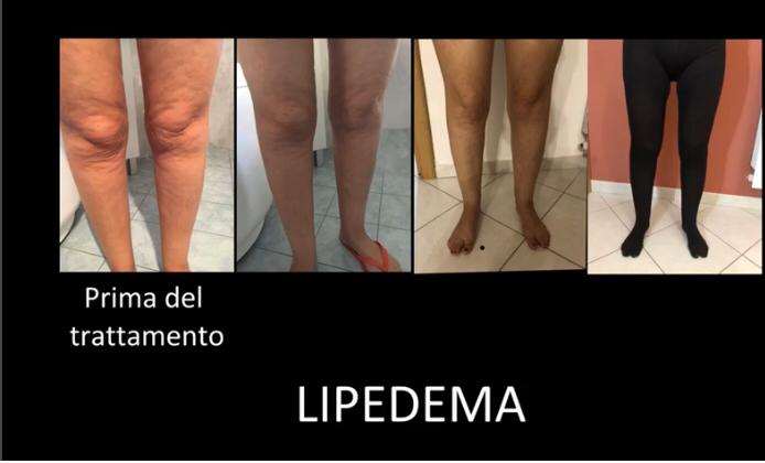 Trattamento di Trigger Point