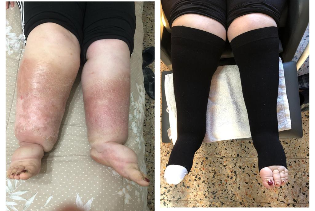 linfedema e lepidema