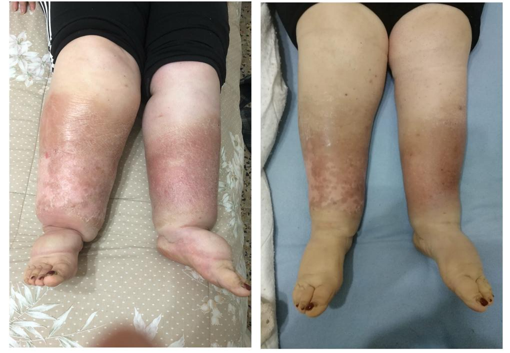 lipedema