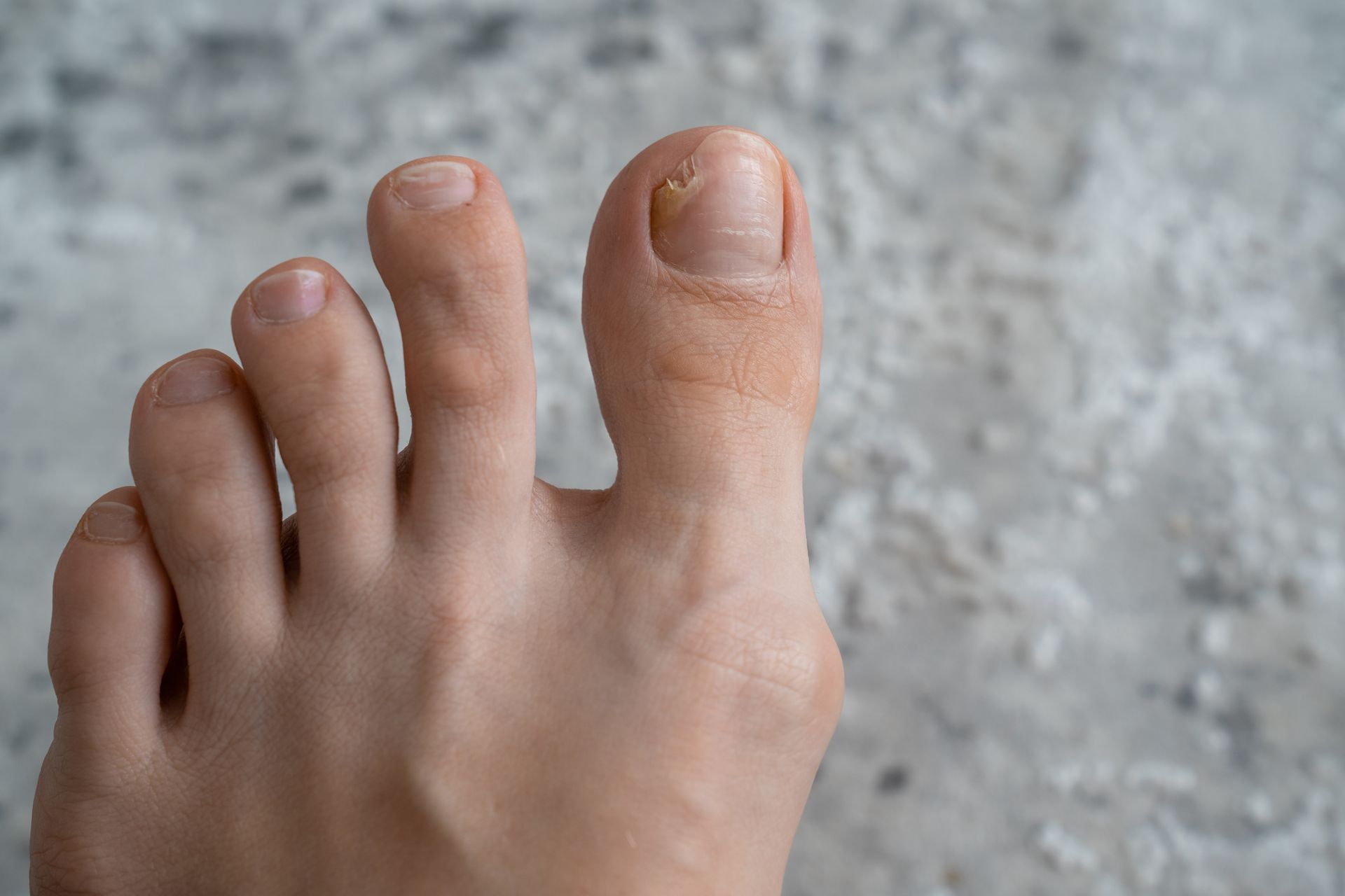 Close-up of a foot with the big toenail discolored and damaged, other toes are healthy.