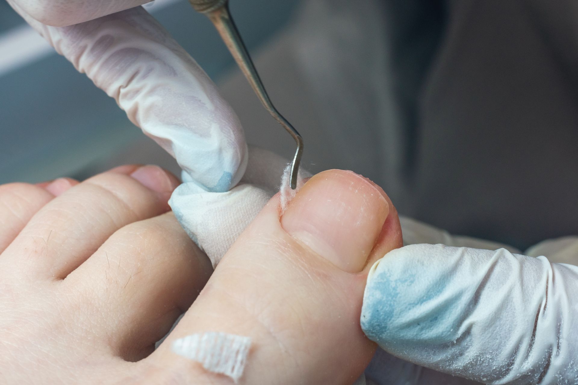 Toe being treated with a tool and gauze by gloved hands. Focus on the toe with the medical procedure.
