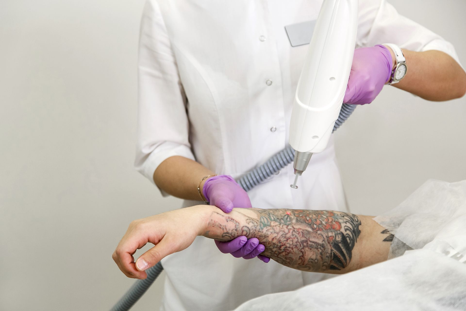 tattoo removal procedure