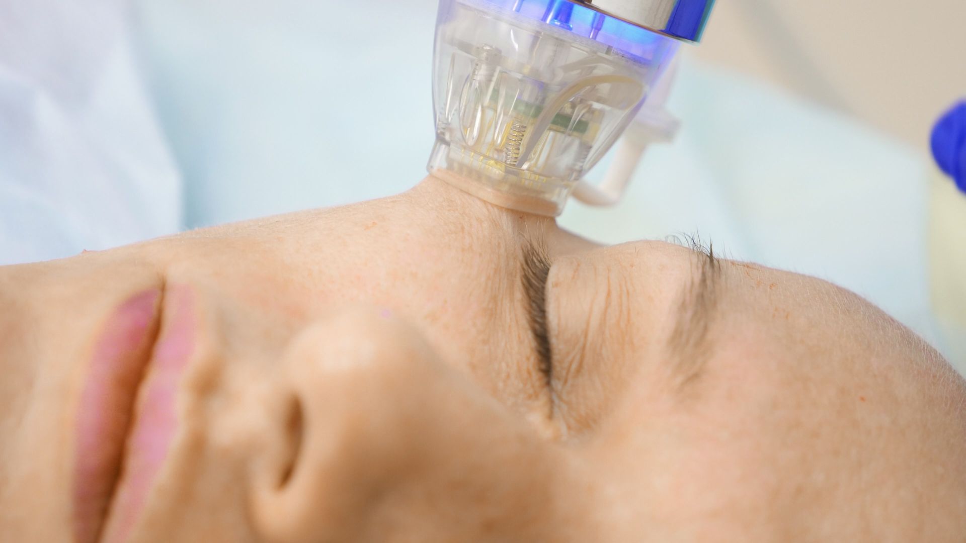 woman receiving radio frequency microneedling treatment