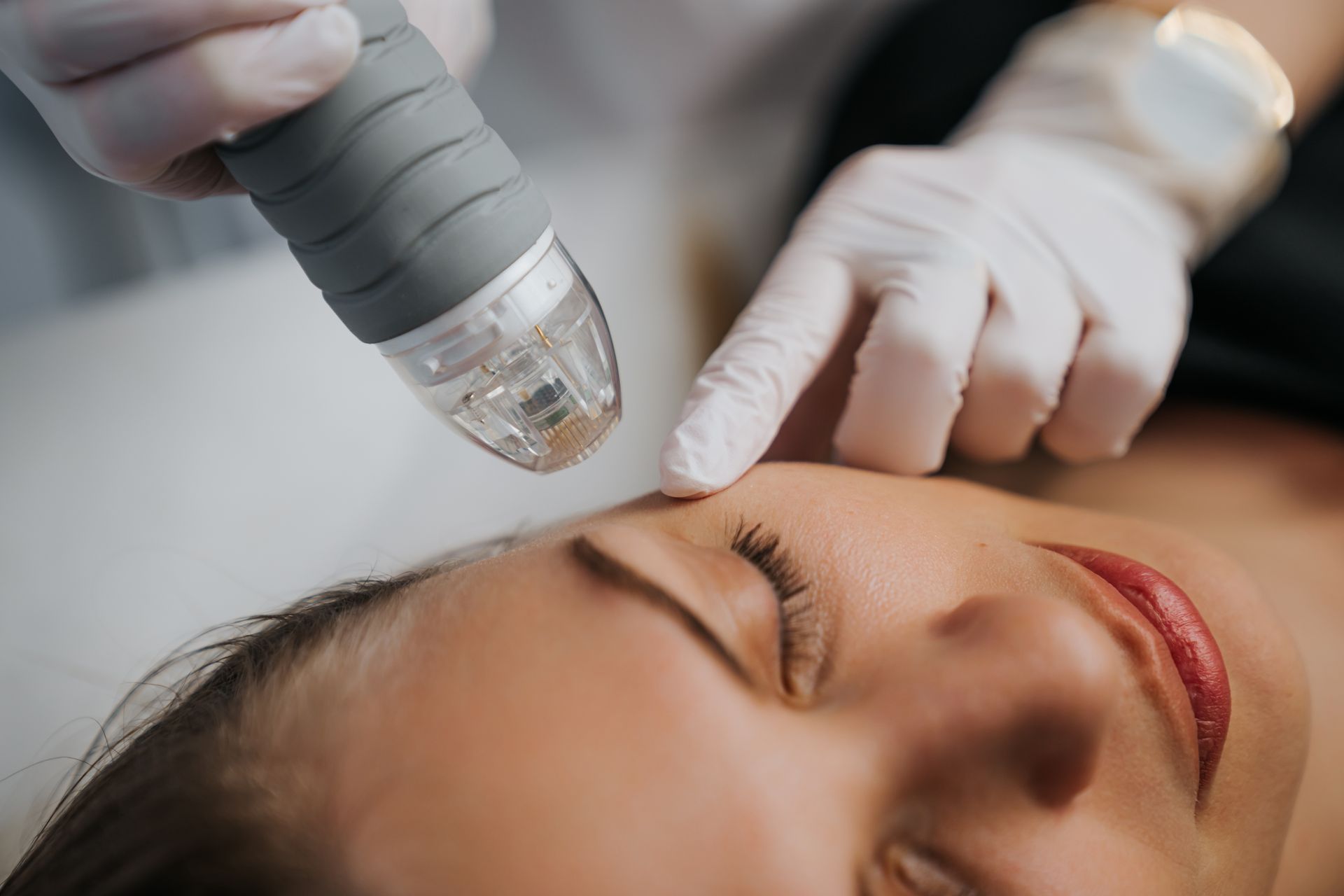woman receiving radio frequency microneedling treatment