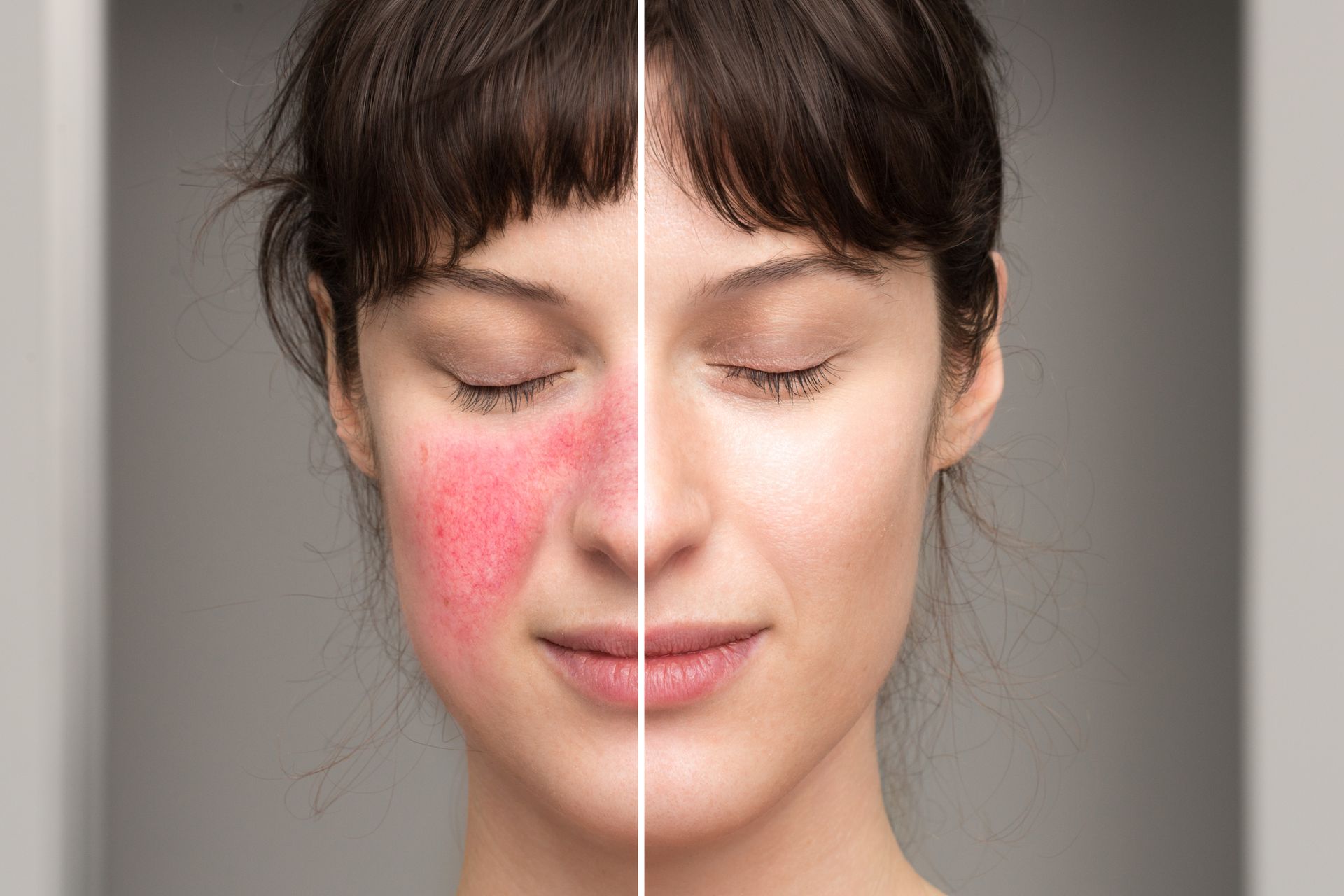 client before and after rosacea treatment