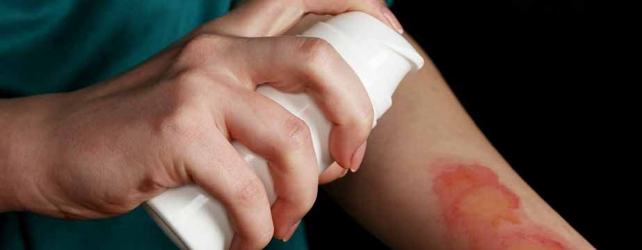 A person is applying ointment to a burn on their arm.