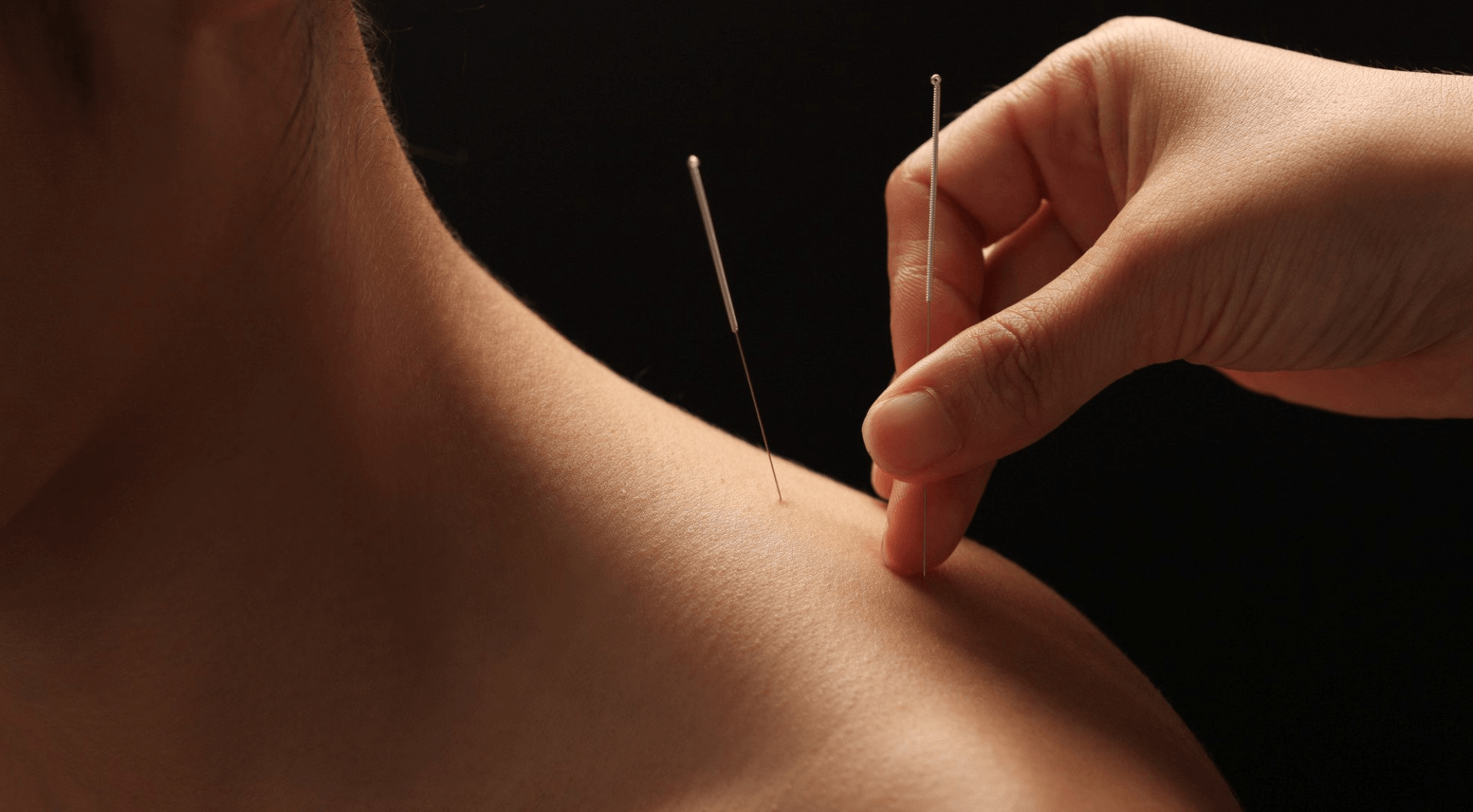Doctor putting acupuncture needles on woman's shoulder